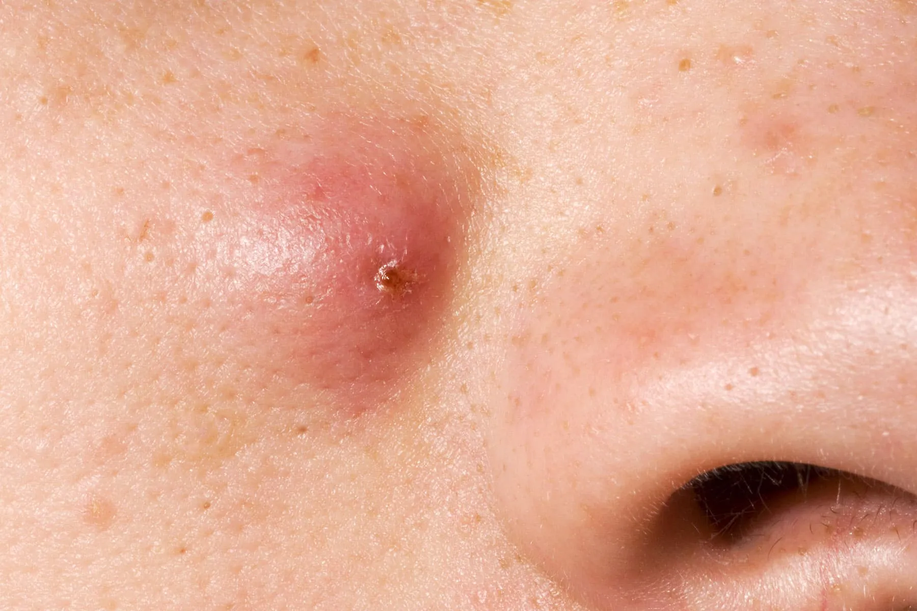 Cyst