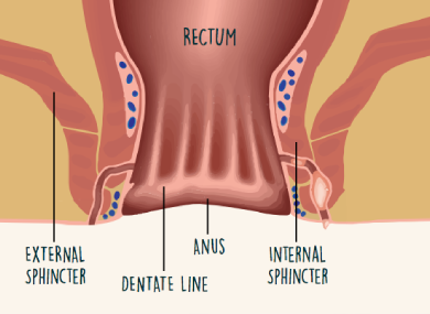 Fistula