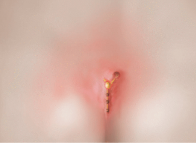 Pilonidal Sinus